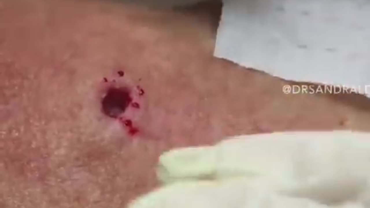 85 Year Old Blackhead Dr Pimple Popper Most Popular Pop of ALL TIME