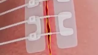 Close a wound without stitches – ZipStitch