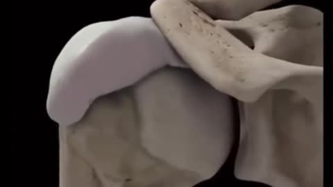 Bursitis