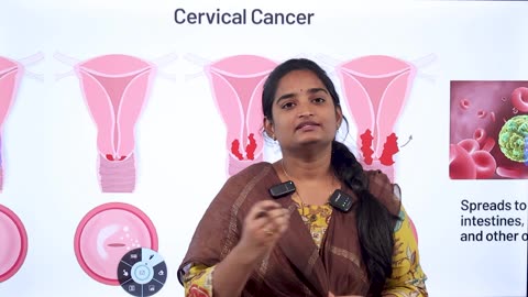 గర్భాశయద్వార కాన్సర్ కి అసలు కారణం The Real Reasons Behind Cervical Cancer | Homeopathy Treatment