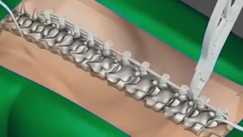 How Scoliosis Surgery Is Performed Scoliosis Surgery 3D Animation