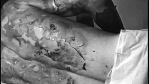 [HENRY FORD HOSPITAL BURN TREATMENT] - [HENRY FORD HOSPITAL BURN TREATMENT] - fc-fc-4110