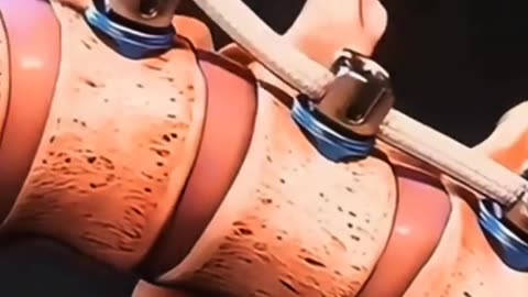 Curved Spine Surgery Explained – How Scoliosis is Treated!