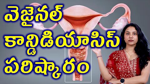 వెజైనల్ కాన్డిడియాసిస్ కి పరిష్కారం Best and Trusted Homeopathy Treatment for Vaginal Candidiasis