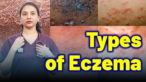 Types of Eczema | Treatment Cure Relief Medicine | Skin Hair Nail | Homeopathy