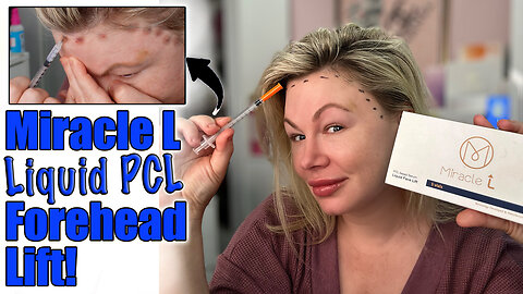 Miracle L (Liquid PCL) Forehead Lift! AceCosm.com and Code Jessica10 Saves