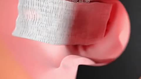 Hemorrhoids Removal Surgery (Hemorrhoidectomy)