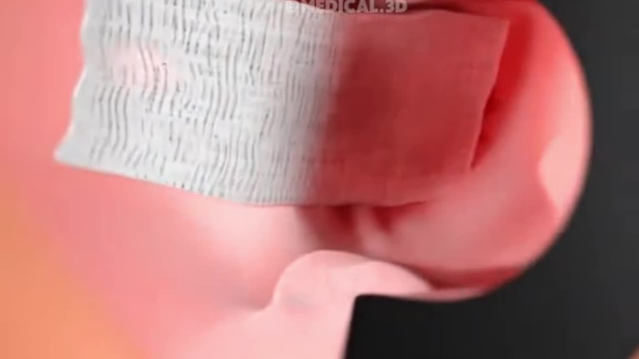 Hemorrhoids Removal Surgery (Hemorrhoidectomy)