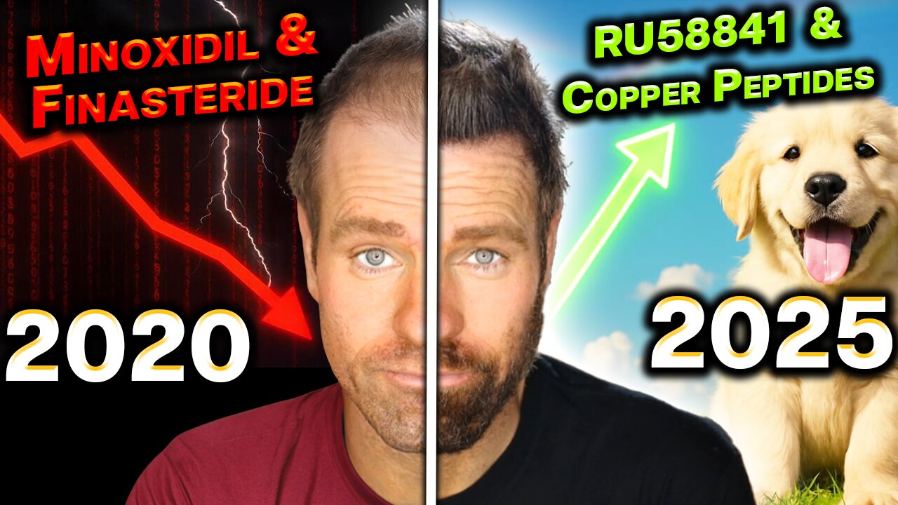 How I Beat Hair Loss, Without Surgery