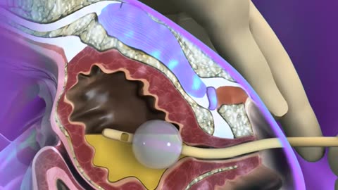 Foley Catheter Procedure 3D Animation