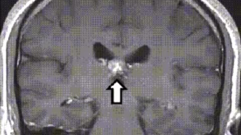 Watch this live Spirometra tapeworm, a few centimeters long, "digging" into the human brain.