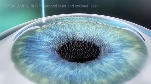 Refractive Surgeries Options - What's Best For You?