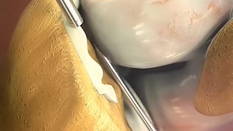 Meniscus Implant Surgery – Restore Knee Function & Relieve Pain