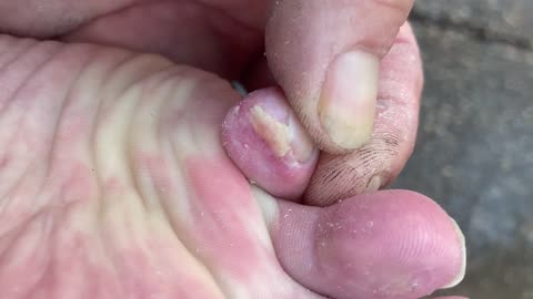 Toe update 12/22/25
