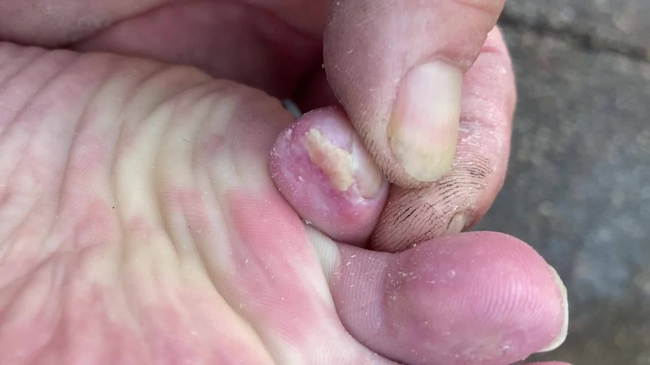 Toe update 12/22/25
