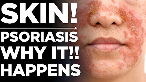 Psoriasis: Why It Happens & How to Manage It 🥲 | Medickpidia