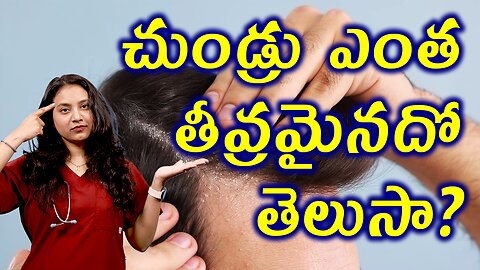 చుండ్రు ఎంత తీవ్రమైందో తెలుసా? What is Dandruff? Dandruff Treatment Statistics | హోమియోపతి