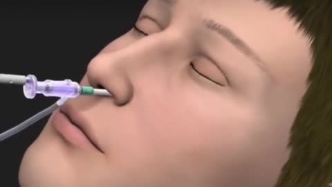 Do You Knw That Why Balloon Sinuplasty Is Performed Balloon Sinuplasty