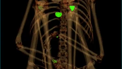 🚨👽 Implants Revealed in Montserrat's DICOM Files! | TheTruthAbove