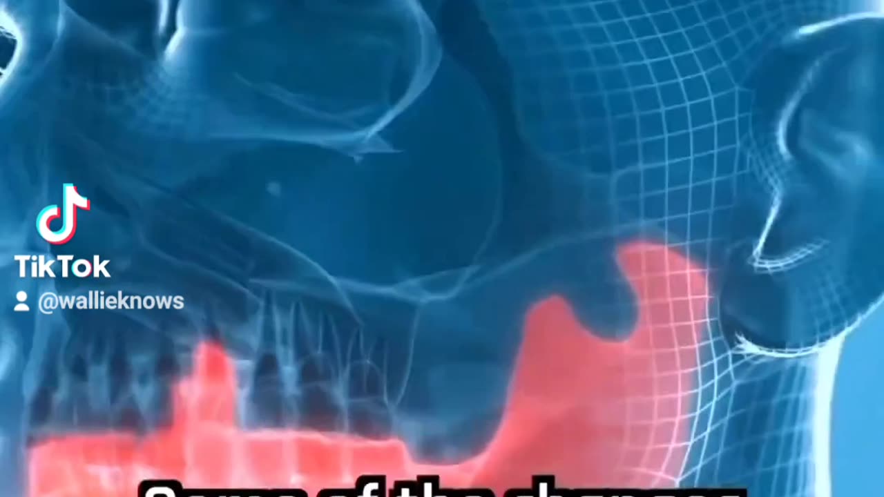 Most babies are being born witout a wisdom tooth