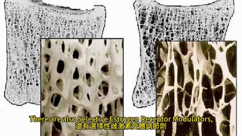 骨質疏鬆 行動力維護