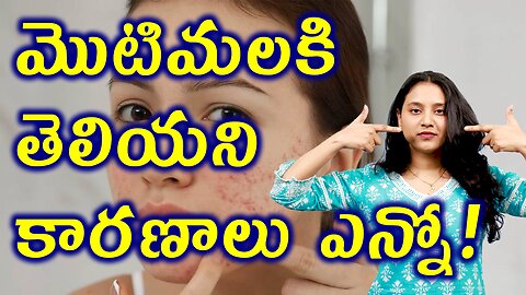 మొటిమలకి తెలియని కారణాలు ఎన్నో Structure Function of Skin and Causes For ACNE, Pimples | హోమియోపతి