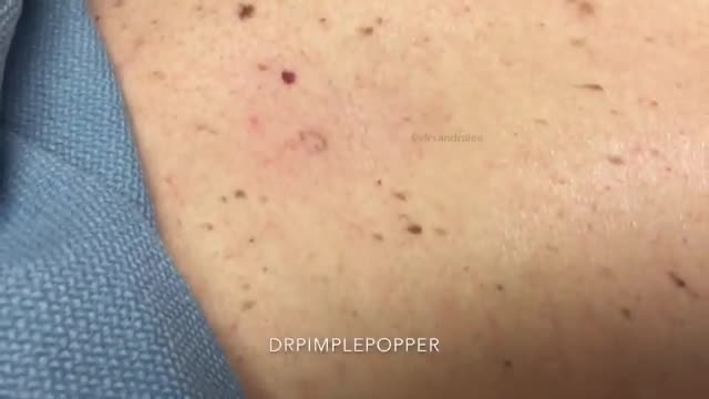 Just two little blackheads on the back