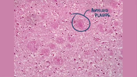 Coronary artery blockage