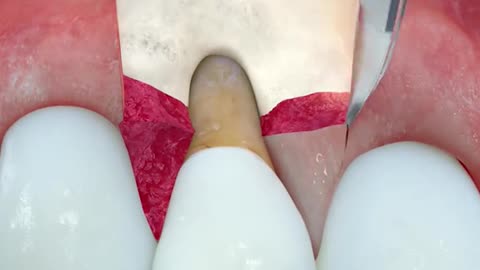 Coronally Advanced Flap Procedure 3D Animation