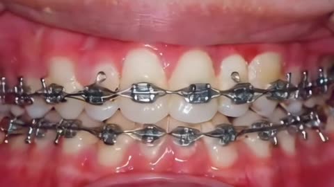 How Braces Works (3D Animation)