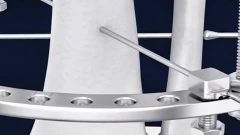 How Doctors Repair Damaged Bones – Amazing Surgical Process!