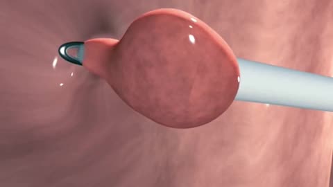 How Colon Polypectomy Is Performed (3D Animation)