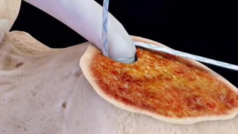 Achilles Tendon Repair Surgery Explained