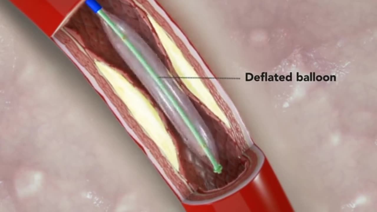 How Angioplasty Procedure Is Performed (3D Animation)