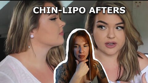 Retro Alex Rodriguez Getting Chin Liposuction And Still Having A Double Chin