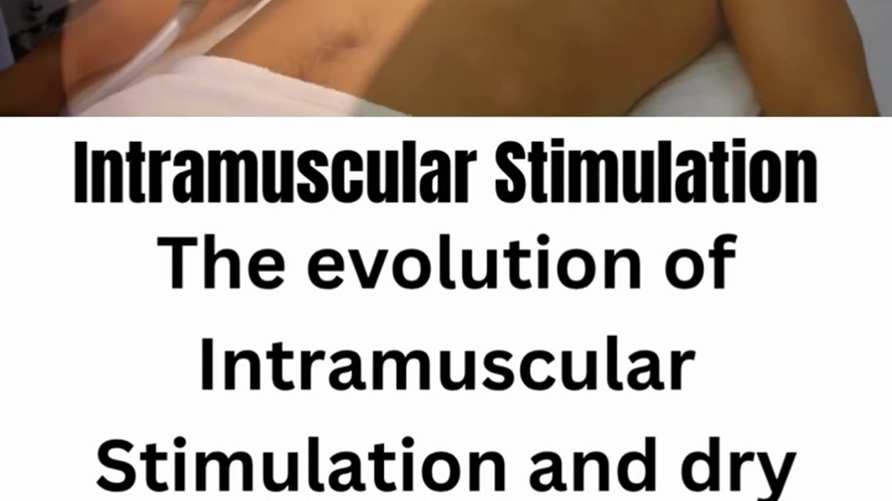 Intramuscular Stimulation & Dry Needling in Langley | Divine Care Physiotherapy Langley BC