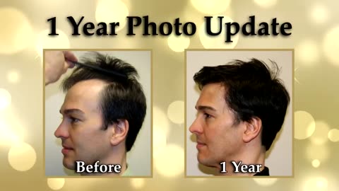 Dr. Brett Bolton Performs Life-Changing Hair Restoration