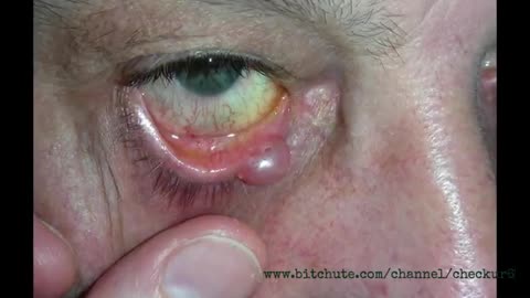 Adverse Event - Video By Checkur6