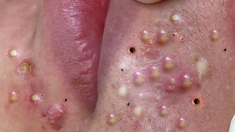 Big Cystic Acne Blackheads Extraction Whiteheads removals pimple popping | Loan nguyen