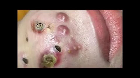 NON-STOP NASTY BLACKHEADS REMOVAL?! 🤮🤮🤮