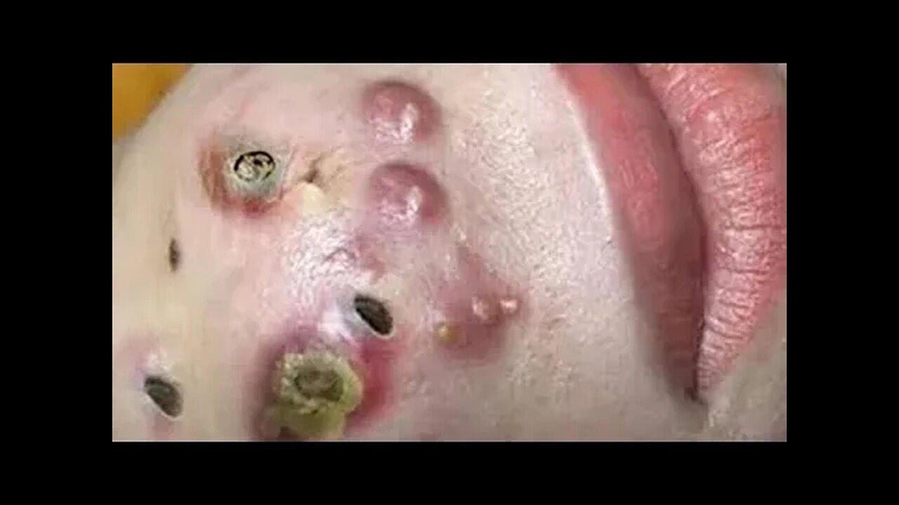 NON-STOP NASTY BLACKHEADS REMOVAL?! 🤮🤮🤮