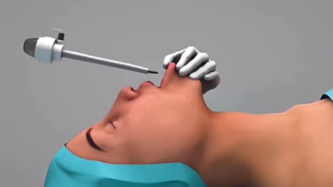 Thyroid Gland Removal Surgery Thyroidectomy (3D Animation)