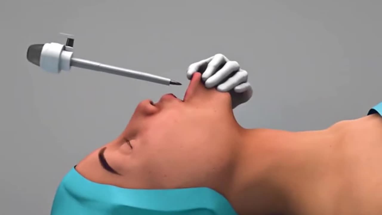 Thyroid Gland Removal Surgery Thyroidectomy (3D Animation)