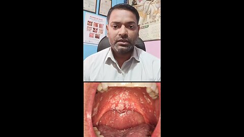 मुंह के छालों का इलाज ।