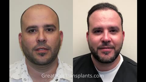 Dr. Brett Bolton Patient Adrien – MaxHarvest™ Plus Surgery Day