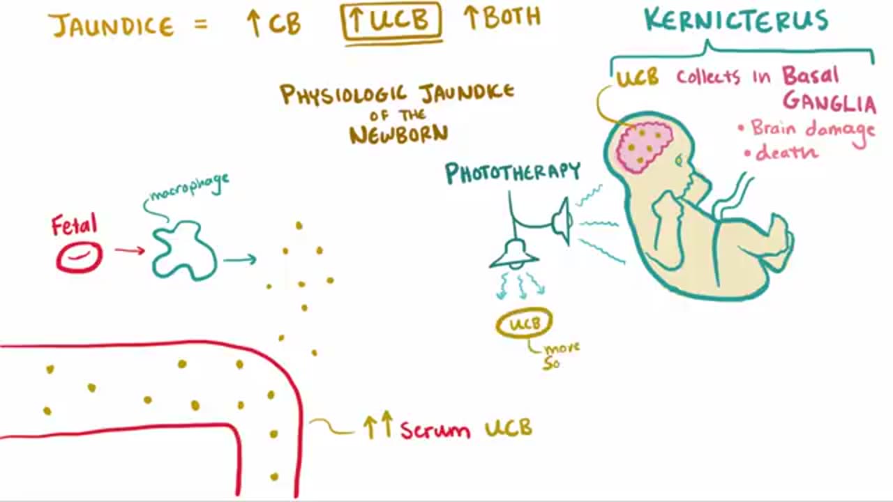 Jaundice - causes, treatment & pathology