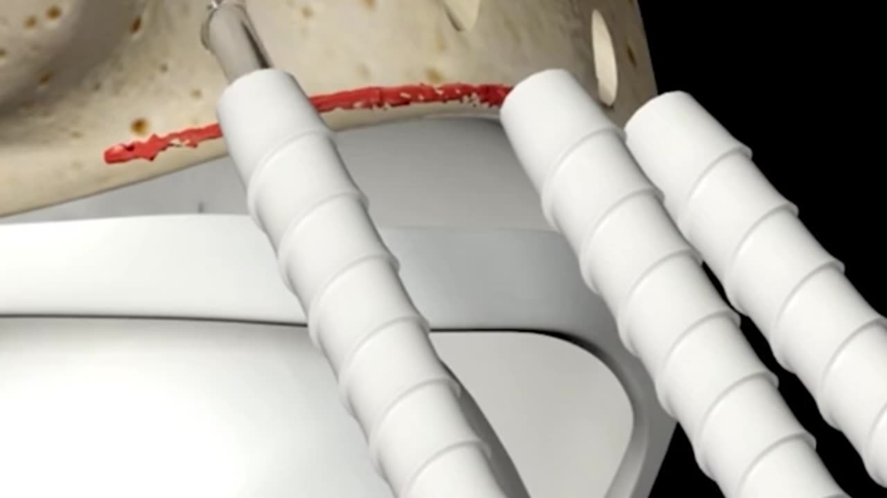 Acetabular Labrum Repair Surgery 3D Animation