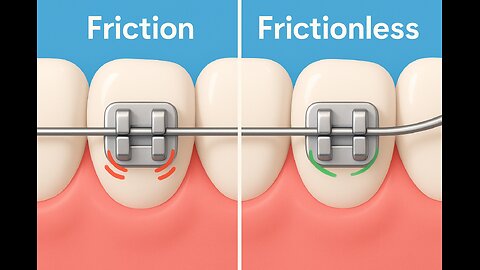 Master Orthodontics: Frictional vs. Frictionless Systems Explained!