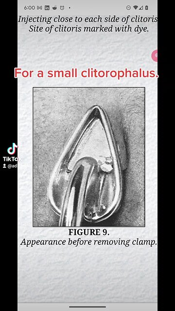 Small and large clitorophallus trimmers