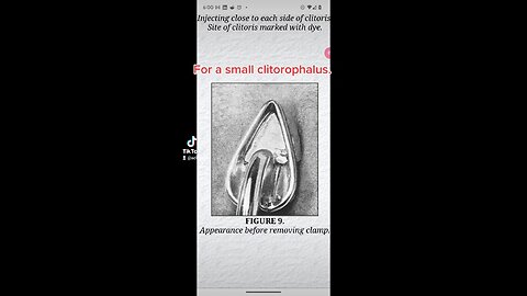 Small and large clitorophallus trimmers